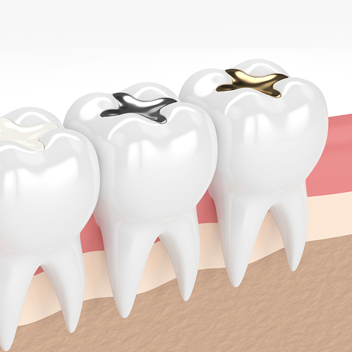 Dental filling treatment in sahakara nagar, dental fillings in bangalore, dental fillings in sahakara nagar, teeth gap filling in sahakar nagar, tooth filling in sahakara nagar, top dental filling services in sahakara nagar