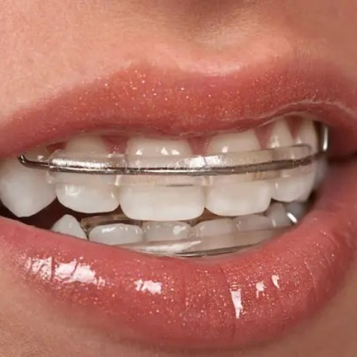 Dental retainers in sahakara nagar, removable retainers in sahakara nagar, retainers cost in sahakarnagar, retainers for teeth alignment in sahakara nagar, retainers for teeth in sahakarnagar, teeth retainers in sahakara nagar