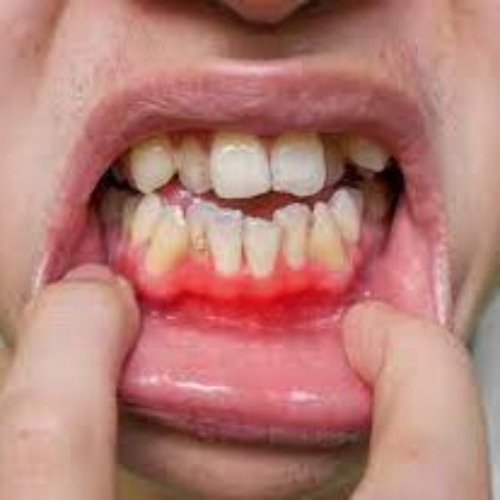 advanced periodontitis treatment in sahakara nagar, periodontal therapy cost, periodontal treatments in sahakara nagar