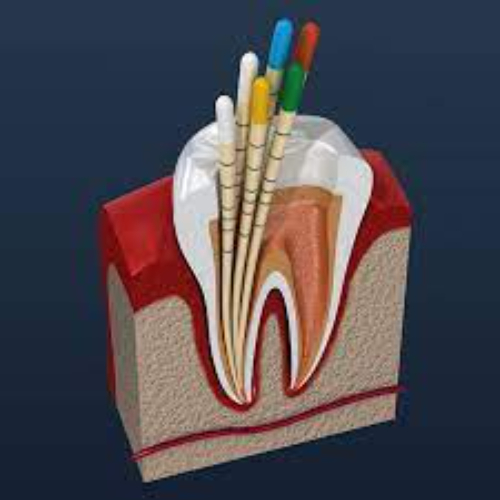 best root canal doctors in sahakara nagar, best root canal treatment in sahakara nagar, painless root canal treatment, root canal doctors in sahakara nagar, root canal specialist, root canal specialist in sahakara nagar, root canal treatment cost in sahakarnagar, root canal treatment in sahakara nagar, tooth root canal in sahakara nagar