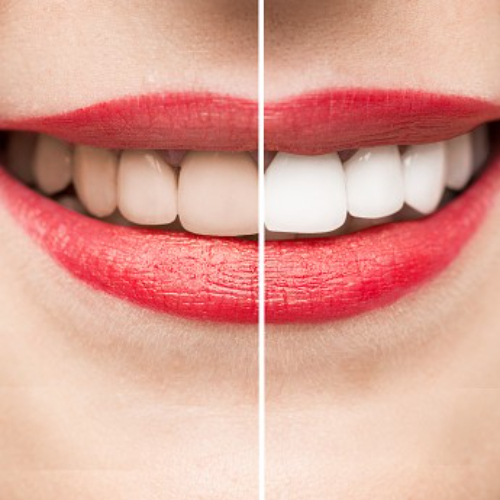 dentist whitening cost, laser teeth whitening in sahakara nagar, teeth bleaching dentist, teeth whitening clinic in sahakara nagar, teeth whitening dentist, teeth whitening dentist cost, teeth whitening in sahakara nagar, teeth whitening service in sahakaranagar
